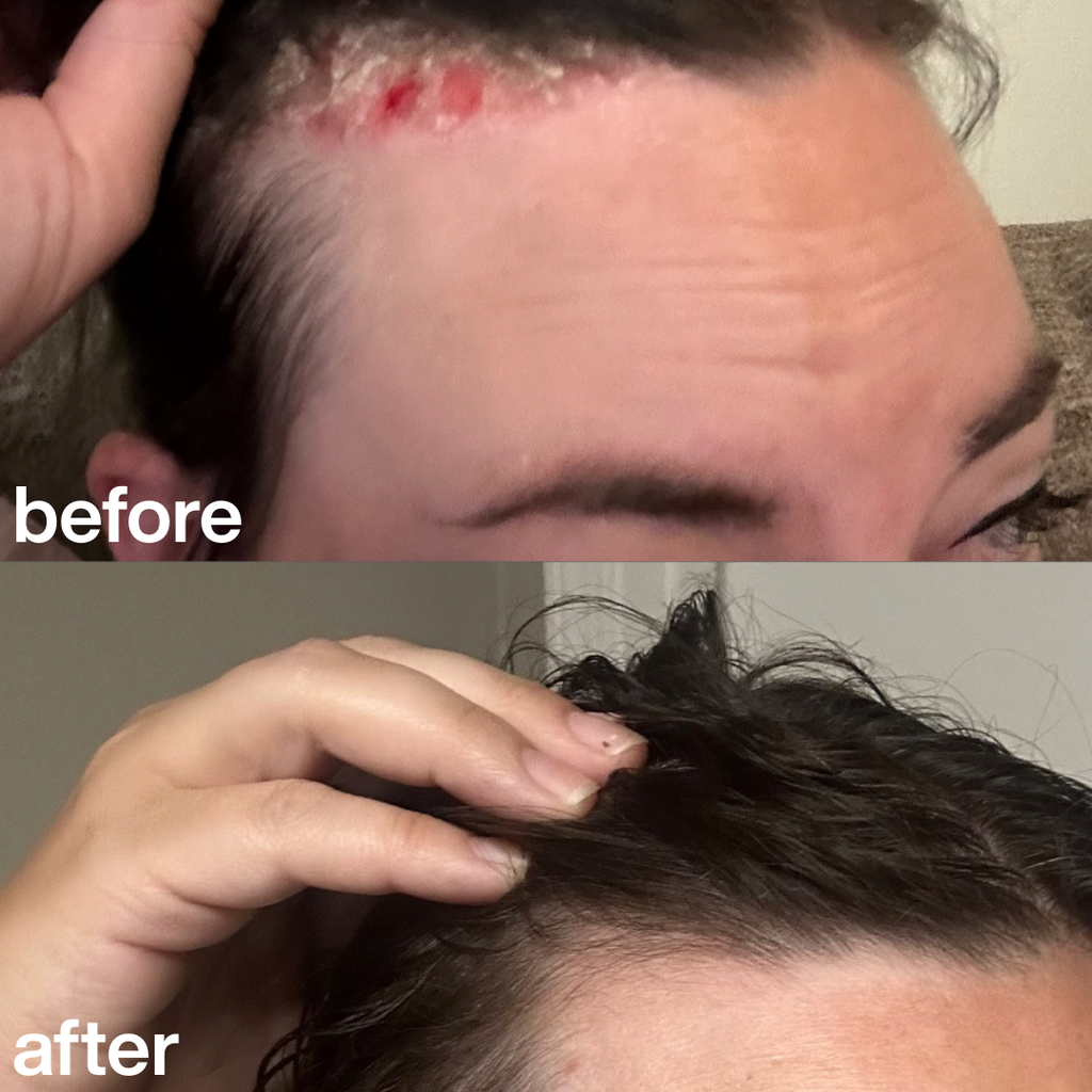 "This scrub is the only thing that helped with the irritation on my scalp." Amelia T