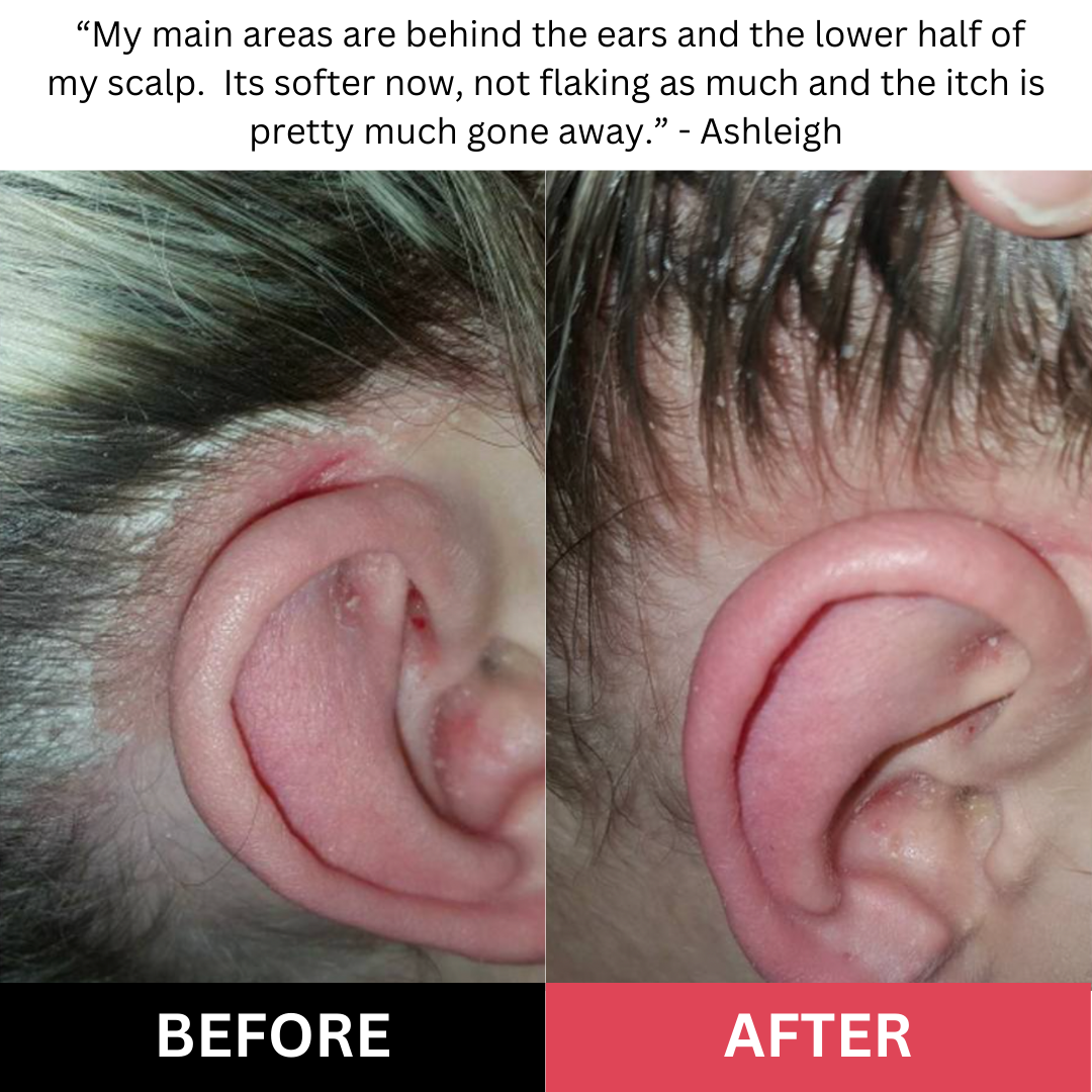 "This scrub is the only thing that helped with the irritation on my scalp." Amelia T