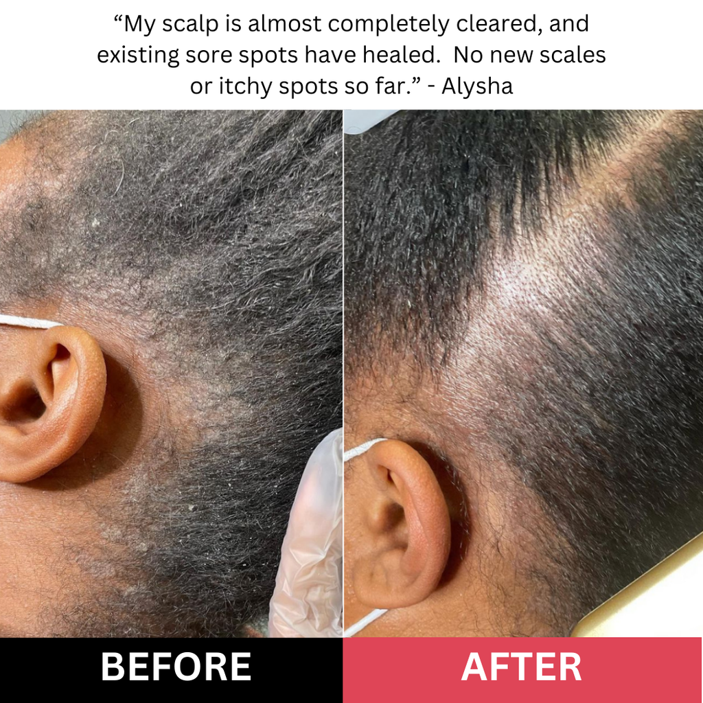 "This scrub is the only thing that helped with the irritation on my scalp." Amelia T