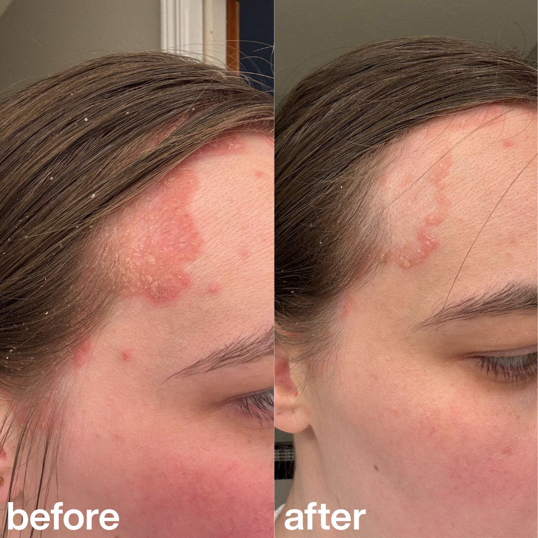 "This scrub is the only thing that helped with the irritation on my scalp." Amelia T