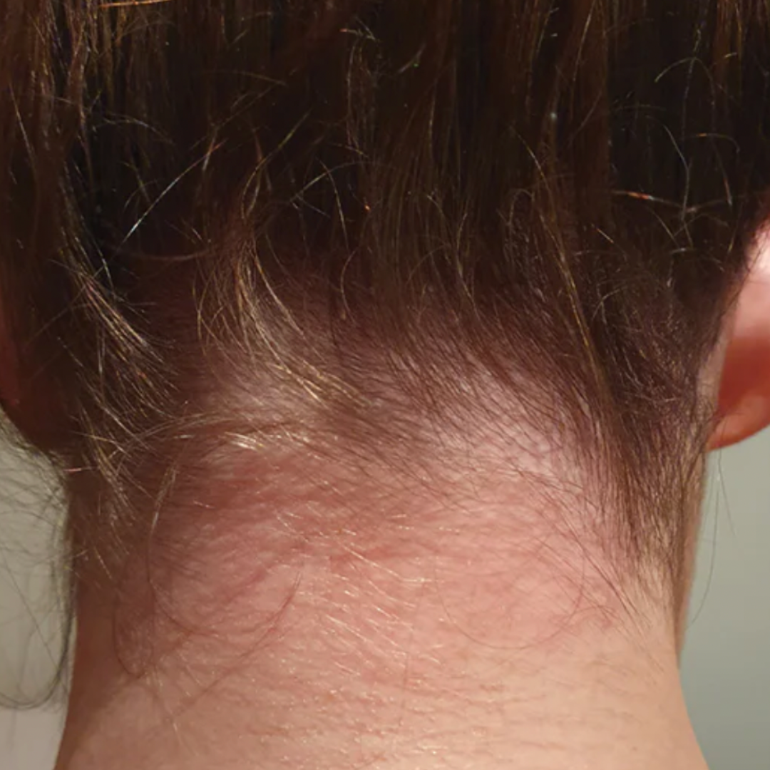 "This scrub is the only thing that helped with the irritation on my scalp." Amelia T