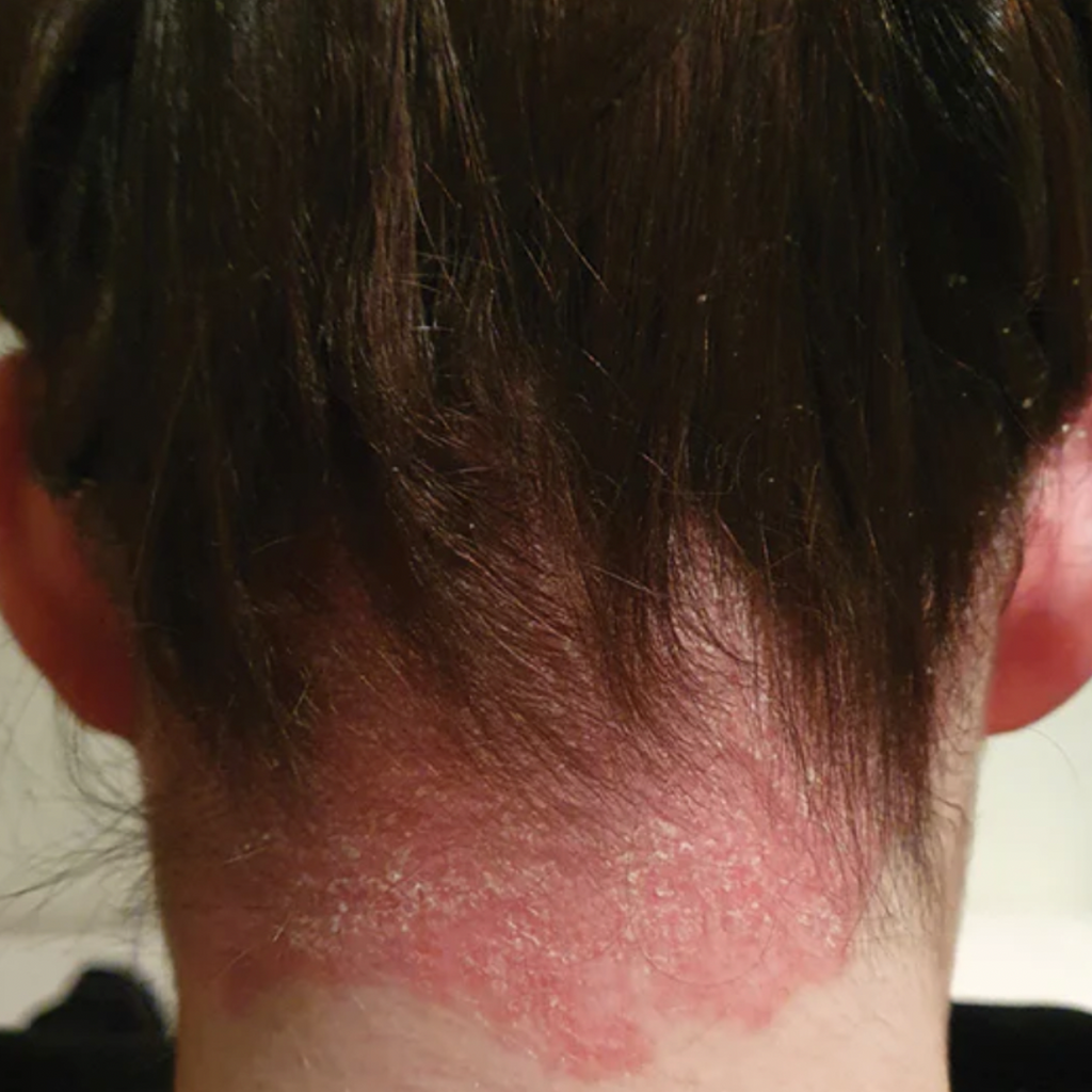 "This scrub is the only thing that helped with the irritation on my scalp." Amelia T